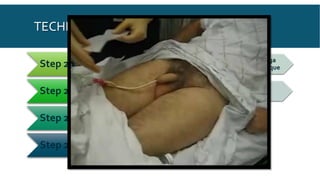 Step 20 Fix
catheter
To medial or
anterior surface
of thigh
No tension
on the
catheter
Omega
Technique
Step 21 ROLLBACK FORESKIN
Step 22 Measure the urine
drained immediately
Step 23 Documentation
TECHNIQUE
 