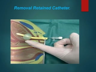 Removal Retained Catheter.
 