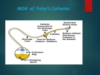 MOA of Foley’s Catheter.
 