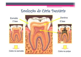 2ª fase
 Esmalte                                 Dentina
   1ª fase                              3ª fase




                                      Polpa




                   Cárie na dentina

Cárie no esmalte                       Cárie na polpa
 