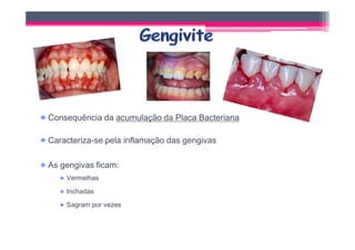 Consequência da acumulação da Placa Bacteriana

Caracteriza-se pela inflamação das gengivas

As gengivas ficam:
    Vermelhas
    Inchadas
    Sagram por vezes
 