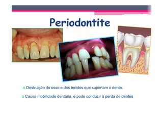 o Destruição do osso e dos tecidos que suportam o dente.

o Causa mobilidade dentária, e pode conduzir à perda de dentes
 