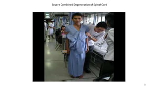 Severe Combined Degeneration of Spinal Cord
33
 