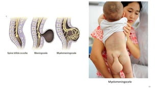 Myelomeningocele
40
 