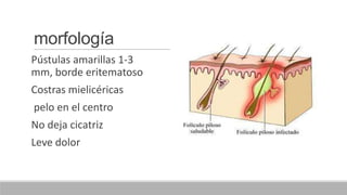 morfología
Pústulas amarillas 1-3
mm, borde eritematoso
Costras mielicéricas
pelo en el centro
No deja cicatriz
Leve dolor