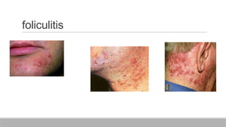 foliculitis