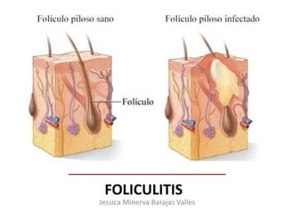 FOLICULITIS
Jessica Minerva Barajas Valles