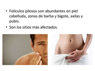 • Folículos pilosos son abundantes en piel
cabelluda, zonas de barba y bigote, axilas y
pubis.
• Son los sitios más afectados.