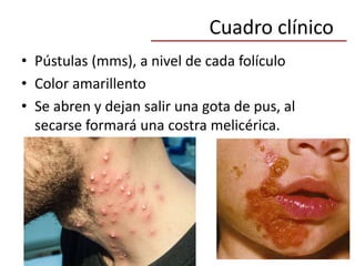 Cuadro clínico
• Pústulas (mms), a nivel de cada folículo
• Color amarillento
• Se abren y dejan salir una gota de pus, al
secarse formará una costra melicérica.