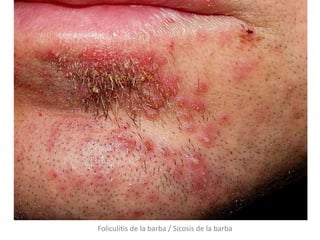 Foliculitis de la barba / Sicosis de la barba