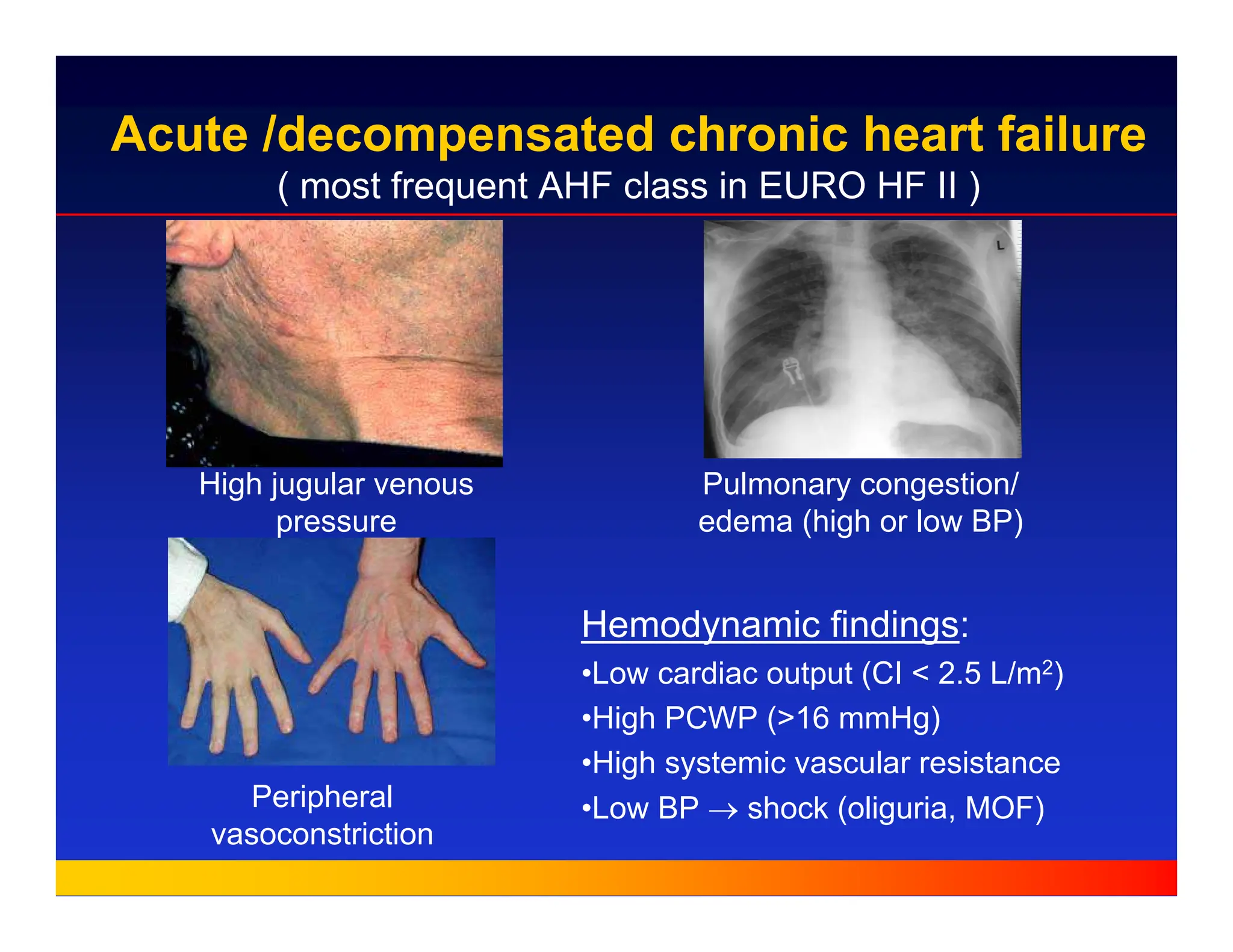 Acute /decompensated chronic heart failure
( most frequent AHF class in EURO HF II )
High jugular venous
pressure
Peripheral
vasoconstriction
Pulmonary congestion/
edema (high or low BP)
Hemodynamic findings:
•Low cardiac output (CI < 2.5 L/m2)
•High PCWP (>16 mmHg)
•High systemic vascular resistance
•Low BP → shock (oliguria, MOF)
 