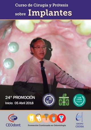 Formación Continuada en Odontología
Curso de Cirugía y Prótesis
24ª PROMOCIÓN
Inicio: 05 Abril 2018
Implantessobre
 