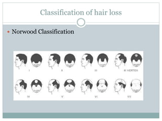 Classification of hair loss
 Norwood Classification
 