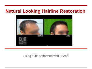 Natural Looking Hairline Restoration
using FUE performed with uGraft
 