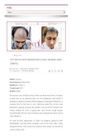 FUT SATYA HAIR TRANSPLANT CLINIC GAURAV 2800
GRAFTS
Posted By : Satya Hair Transplant Clinic
Categorized : FUT-Strip Method
29 Jan 2011
Name: Gaurav
City/Country: Delhi/ India
Baldness: Grade V
T reatment: FUT
Grafts: 2800
Twenty-five year old Gaurav from Delhi was distressed when he began
to lose hair at an alarming rate. He was diagnosed with Grade 5
androgenic alopecia or Male pattern baldness. Androgenic alopecia is a
common form of hair loss in men, affecting about 70% of the male
population, typically present with hairline recession at the temples and
vertex balding. At such a young age, loss of hair made Gaurav
uncomfortable with the way he looked, and consequently led to loss of
self-confidence.
He tried several approaches to solve his problem, going by both
homeopathic and Ayurvedic medicine, but to no avail. After many
disappointments, which lead to no improvement, finally, he decided to
come to Satya clinic.
Menu
 