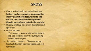 GROSS
• Characterised by four cardinal features:
Solitary nodule ,complete encapsulation
clearly distinct architecture inside and
outside the capsule and compressed
thyroid parenchyma outside the capsule.
• Usually small(up to 3 cm in diameter) and
spherical.
• On cut section,
The tumor is grey-white to red-brown,
and less colloidal than the surrounding
thyroid parenchyma.
• Secondary changes :- Fibrous scarring ,
focal calcification haemorrhages and cyst
formation.
 
