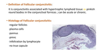 follicular conjunctivitis histology