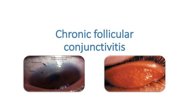 Eye Allergy Drops >> Follicular conjunctivitis (1) Eye Allergy Drops >> Follicular conjunctivitis (1)