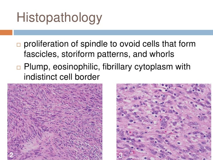 Follicular dendritic cell sarcoma