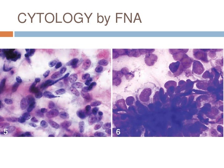 Follicular Dendritic Cell Sarcoma Prognosis
