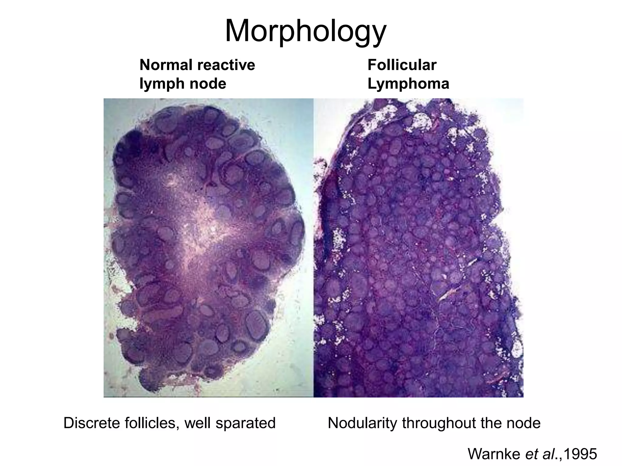 follicular lymphoma PPT无注释.ppt | Cancer | Diseases and Conditions