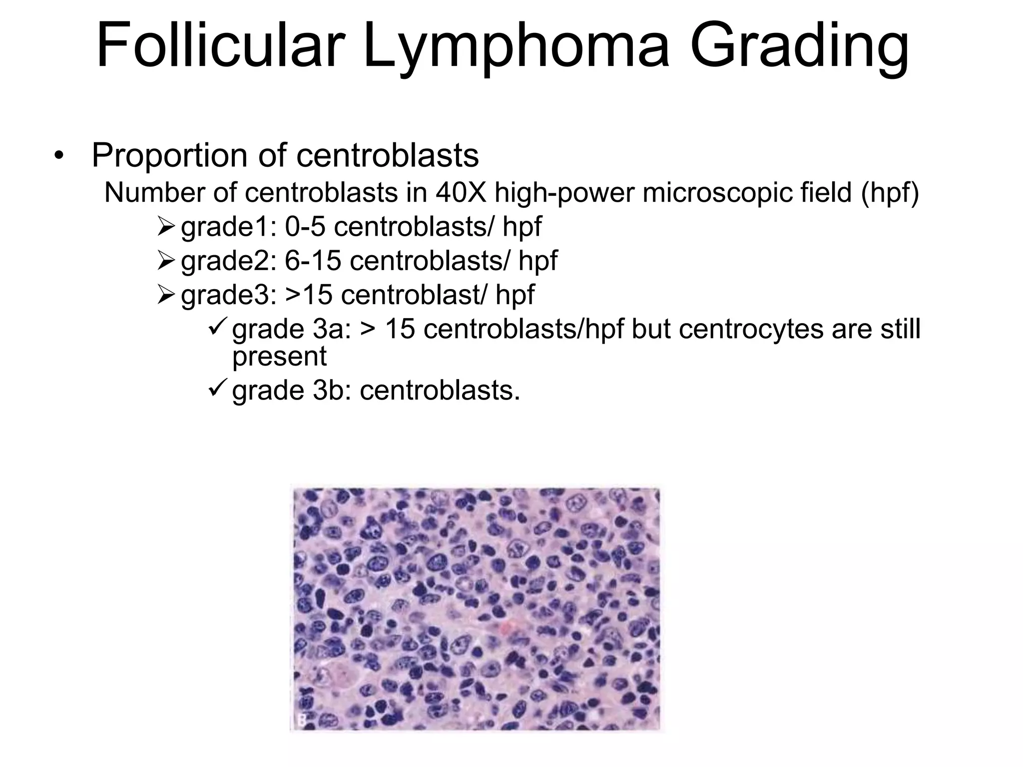 follicular lymphoma PPT无注释.ppt | Cancer | Diseases and Conditions