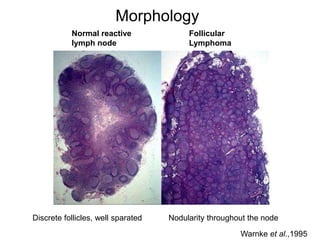 Normal reactive
lymph node
Follicular
Lymphoma
Morphology
Warnke et al.,1995
Discrete follicles, well sparated Nodularity throughout the node
 