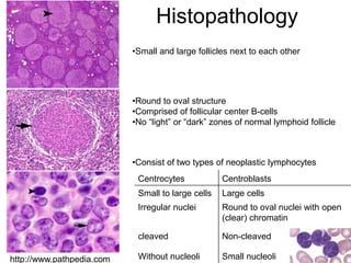 Histopathology
http://www.pathpedia.com
•Small and large follicles next to each other
•Round to oval structure
•Comprised of follicular center B-cells
•No “light” or “dark” zones of normal lymphoid follicle
Centrocytes Centroblasts
Small to large cells Large cells
Irregular nuclei Round to oval nuclei with open
(clear) chromatin
cleaved Non-cleaved
Without nucleoli Small nucleoli
•Consist of two types of neoplastic lymphocytes
 