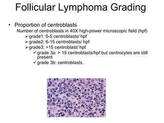 Follicular Lymphoma Grading
• Proportion of centroblasts
Number of centroblasts in 40X high-power microscopic field (hpf)
grade1: 0-5 centroblasts/ hpf
grade2: 6-15 centroblasts/ hpf
grade3: >15 centroblast/ hpf
grade 3a: > 15 centroblasts/hpf but centrocytes are still
present
grade 3b: centroblasts.
 