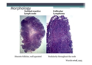 Normal reactive
lymph node
Follicular
Lymphoma
Morphology
Warnke et al.,1995
Discrete follicles, well sparated Nodularity throughout the node
 