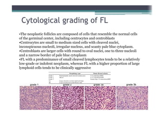 Cytological grading of FL
•The neoplastic follicles are composed of cells that resemble the normal cells
of the germinal center, including centrocytes and centroblasts
•Centrocytes are small to medium sized cells with cleaved nuclei,
inconspicuous nucleoli, irregular nucleus, and scanty pale blue cytoplasm.
•Centroblasts are larger cells with round to oval nuclei, one to three nucleoli
and a narrow border of pale blue cytoplasm
•FL with a predominance of small cleaved lymphocytes tends to be a relatively
low-grade or indolent neoplasm, whereas FL with a higher proportion of large
lymphoid cells tends to be clinically aggressive
 
