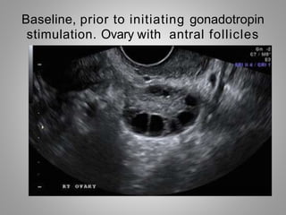 Baseline, prior to initiating gonadotropin
stimulation. Ovary with antral follicles
 