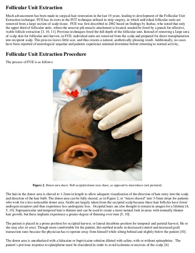 Follicular Unit Extraction Hair Transplant Harvest: A Review of Curre…