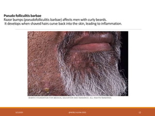 Pseudofolliculitis barbae
Razor bumps (pseudofolliculitis barbae) affects men with curly beards.
It develops when shaved hairs curve back into the skin, leading to inflammation.
3/2/2020 @NOBLE AJUNA 2020. 12
 