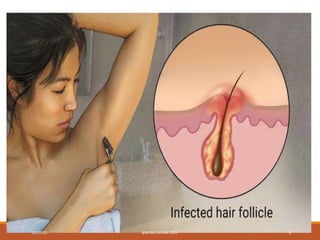Folliculitis  Symptoms Types and Treatments