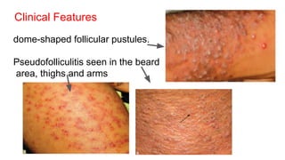 Clinical Features
dome-shaped follicular pustules.
Pseudofolliculitis seen in the beard
area, thighs and arms
 