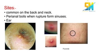 Sites:-
• common on the back and neck.
• Perianal boils when rupture form sinuses.
• Ear
 