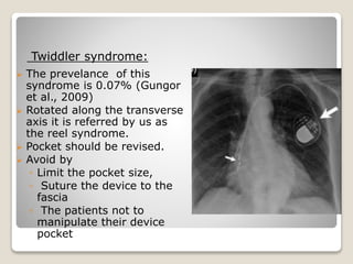 Follow up and management of pacemaker programming and | PPTX