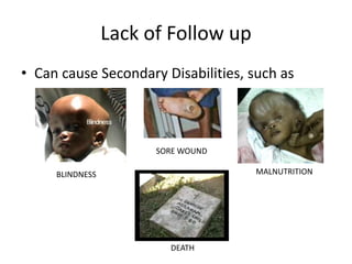 Lack of Follow up
• Can cause Secondary Disabilities, such as



                       SORE WOUND

     BLINDNESS                       MALNUTRITION




                         DEATH
 