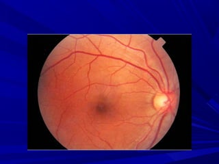 FUNDOSCOPIA. METODO DE ESTUDO