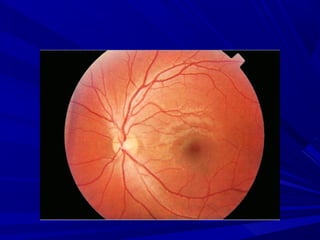 FUNDOSCOPIA. METODO DE ESTUDO