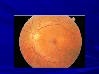 FUNDOSCOPIA. METODO DE ESTUDO