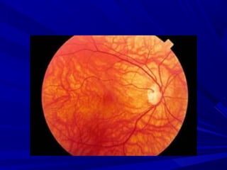 FUNDOSCOPIA. METODO DE ESTUDO