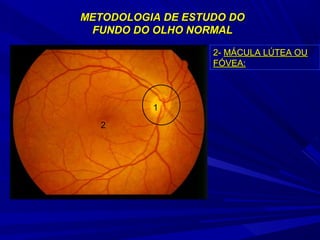 METODOLOGIA DDEE EESSTTUUDDOO DDOO 
FFUUNNDDOO DDOO OOLLHHOO NNOORRMMAALL 
1 
2 
22-- MMÁÁCCUULLAA LLÚÚTTEEAA OOUU 
FFÓÓVVEEAA:: 
 