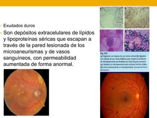 • Exudados duros
• Son depósitos extracelulares de lípidos
y lipoproteínas séricas que escapan a
través de la pared lesionada de los
microaneurismas y de vasos
sanguíneos, con permeabilidad
aumentada de forma anormal.
 