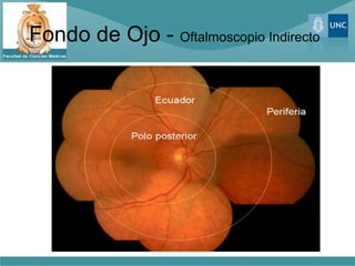 Fondo de Ojo - Oftalmoscopio Indirecto
 