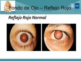 Fondo de Ojo – Reflejo Rojo
Reflejo Rojo Normal
 