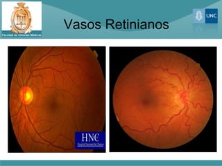 Vasos Retinianos
 