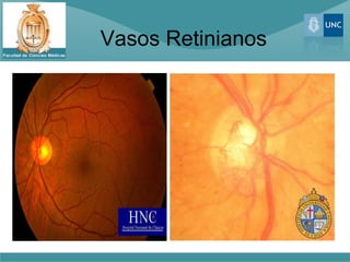 Vasos Retinianos
 