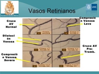 Vasos Retinianos
                               Compresió
  Cruce                         n Venosa
    AV                            Leve
  Normal


Dilataci
   ón
Venosa
                                Cruce AV
                                  Pre-
                                 Tromb.
Compresió
 n Venosa
  Severa
 